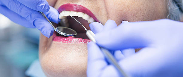 Best Emergency Wisdom Teeth Removal in Stlman Valley, IL